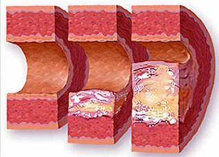 Stages of development of atherosclerotic plaque in a vessel with hypertension